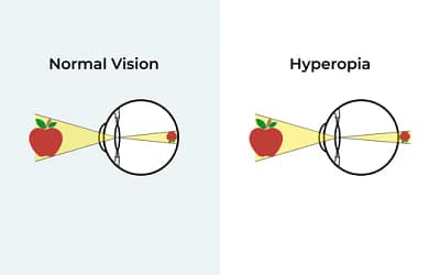 Hyperopia (Long-sightedness)