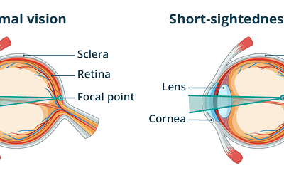 Myopia (Short-sightedness)
